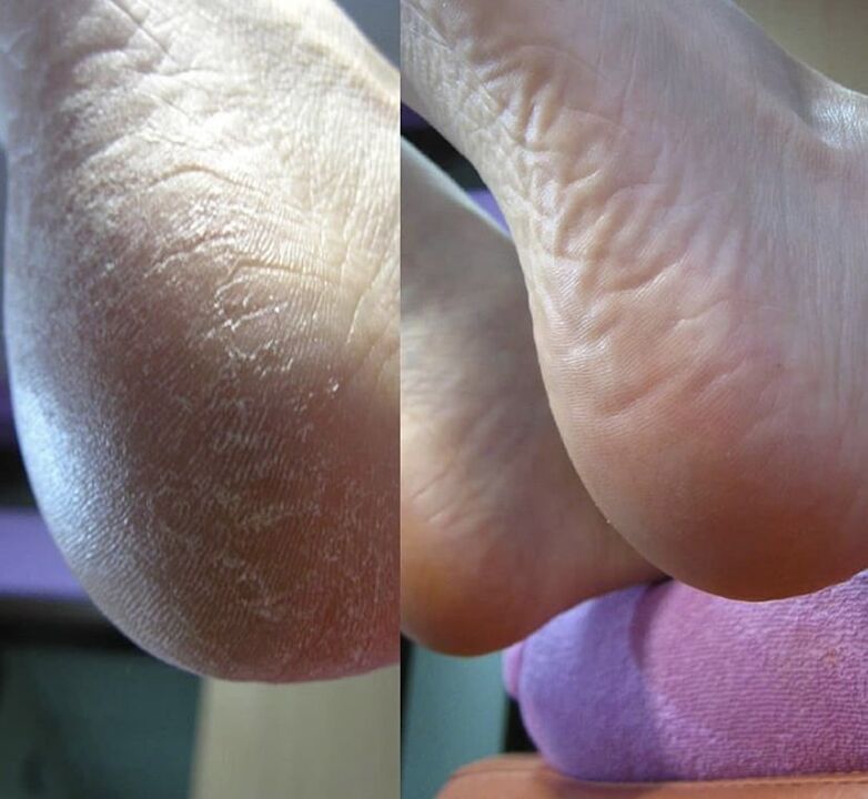 Foto del talón del pie antes y después de usar la crema Zenidol