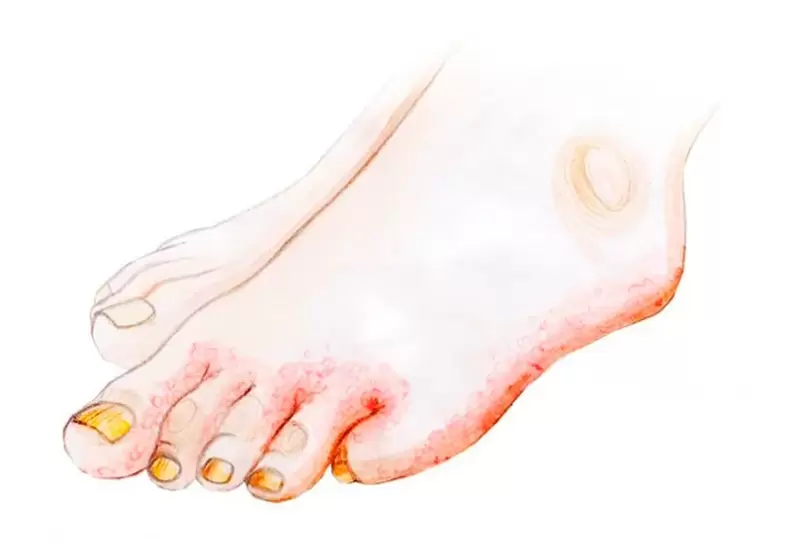 Hongos en los dedos de los pies y cómo aplicar la crema Zenidol