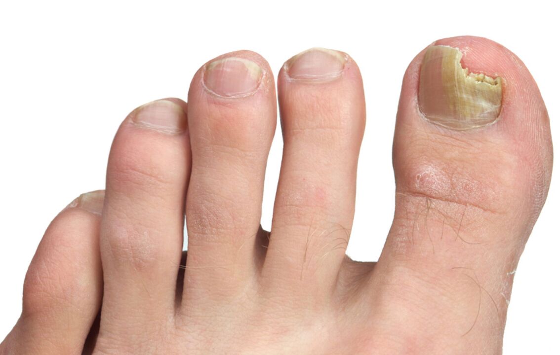 foto de hongos en las uñas de los pies