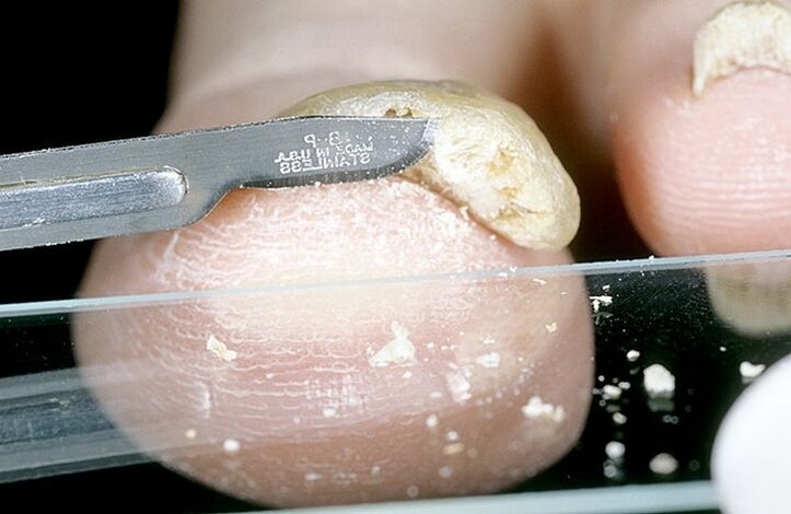 raspado de uñas para diagnosticar hongos