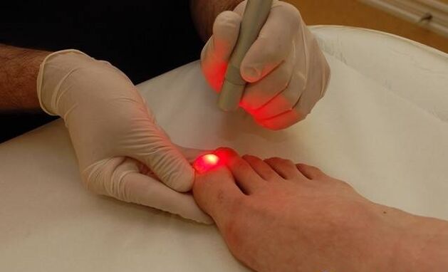 tratamiento con láser para hongos en las uñas de los pies