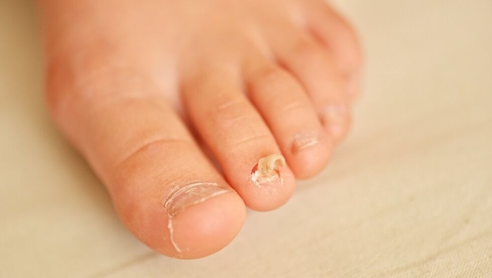 síntomas de hongos en las uñas de los pies
