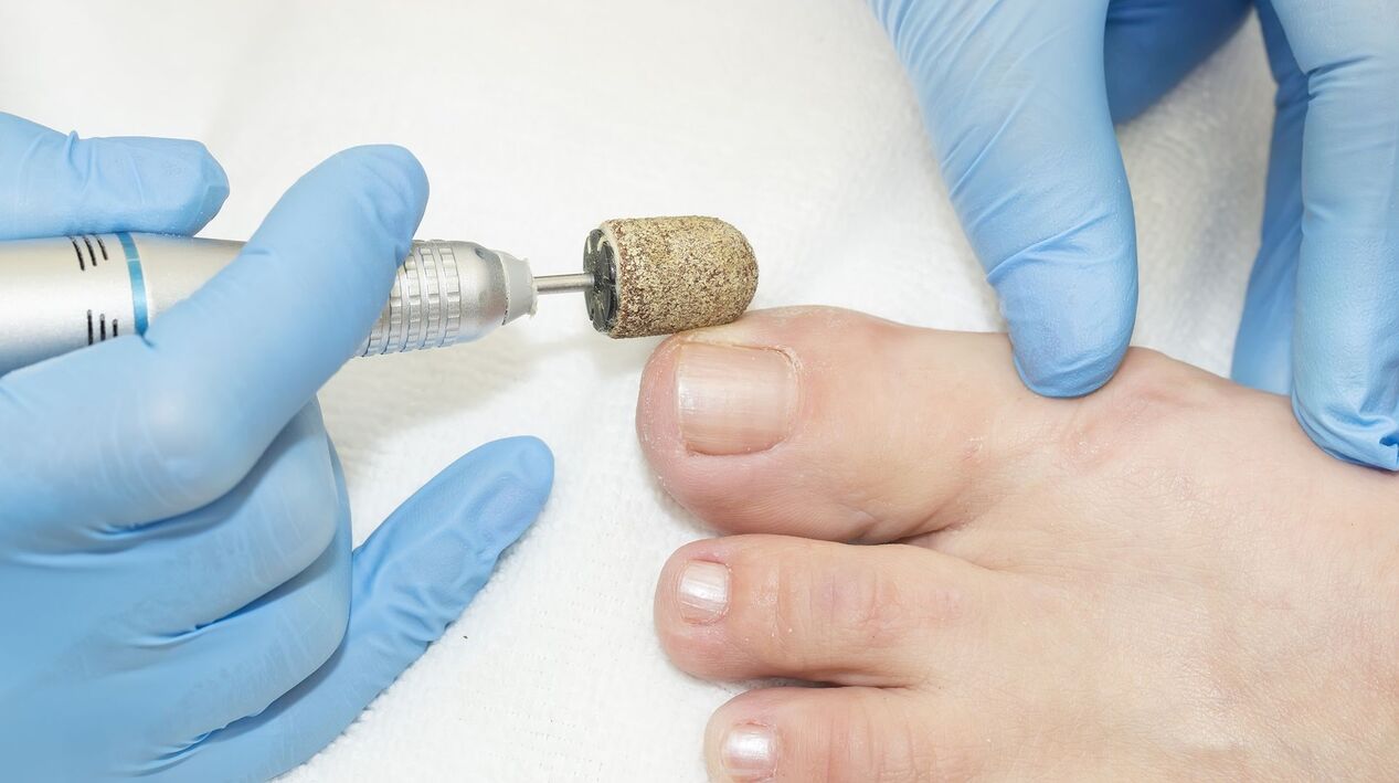 tratamiento de hardware de hongos en las uñas de los pies
