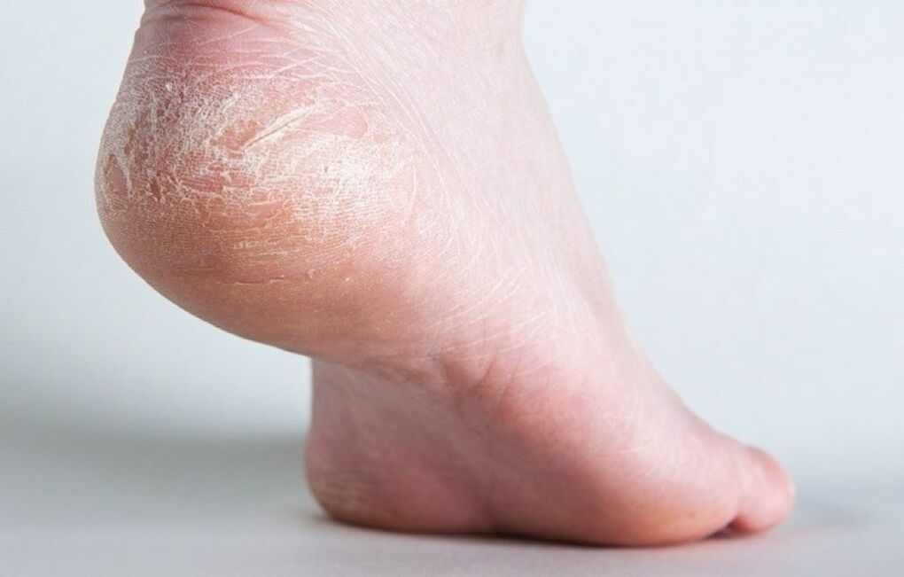 hongos en la piel de la pierna como tratar