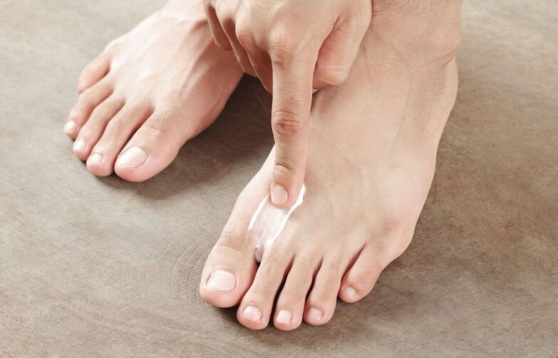 pomada para el tratamiento de hongos en las uñas de los pies