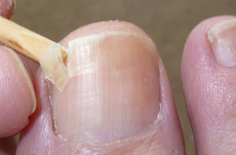 Las uñas dañadas son un factor de riesgo de infección por hongos