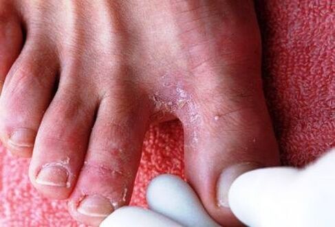 hongos entre los dedos de los pies
