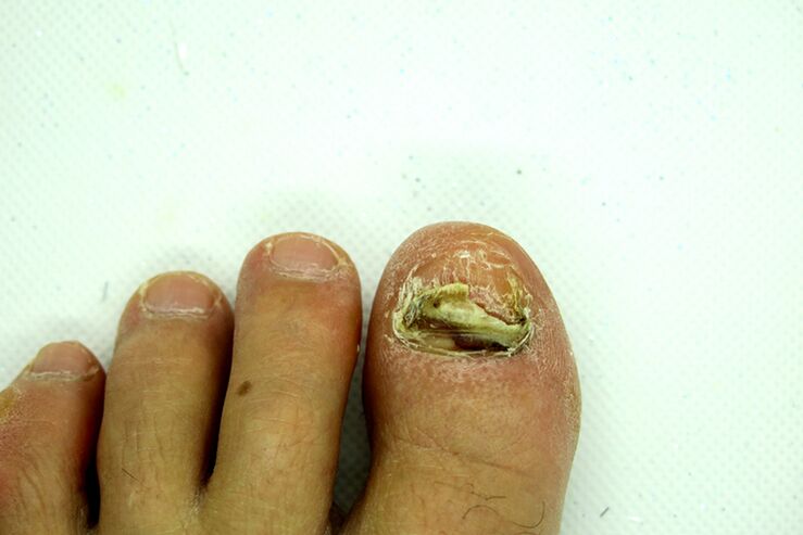 Hongo de las uñas de los dedo - Etapa pesada