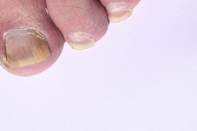 La etapa inicial de la micosis de las uñas en las piernas