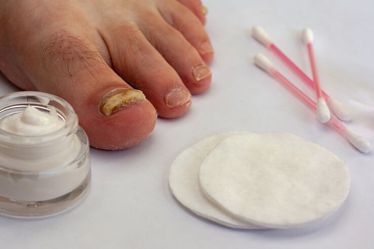 Tratamiento del hongo de los dedos con crema del hongo