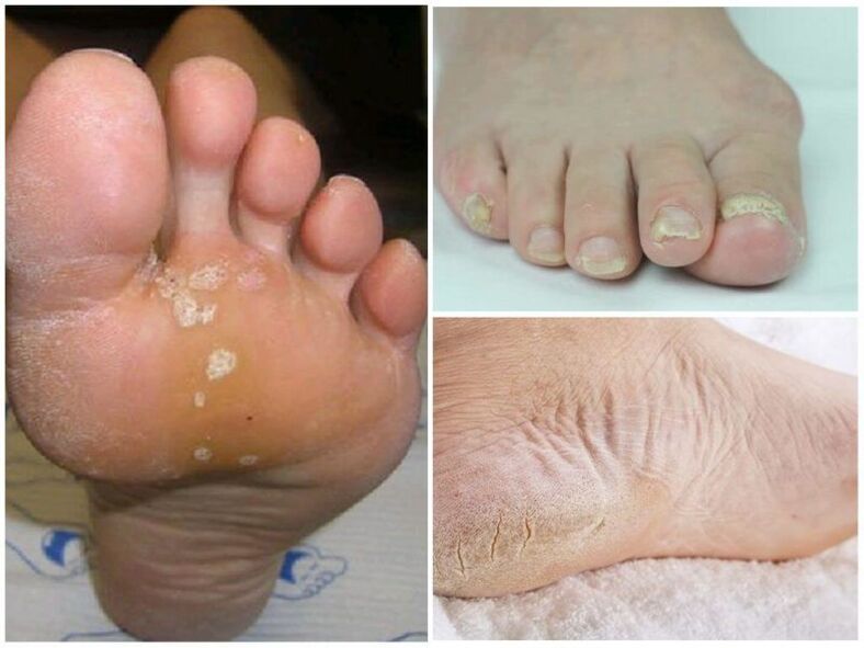 Síntomas de micosis