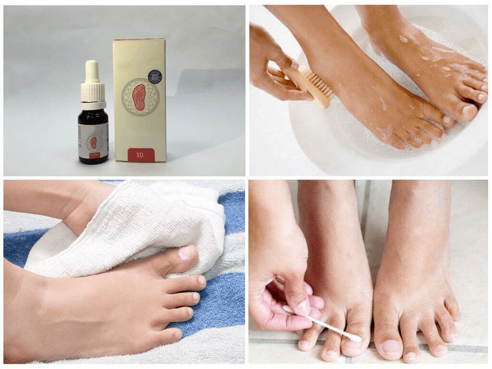 Varios remedios para los hongos en los pies.