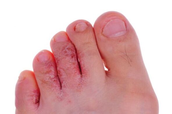 enfermedad fúngica de los dedos de los pies
