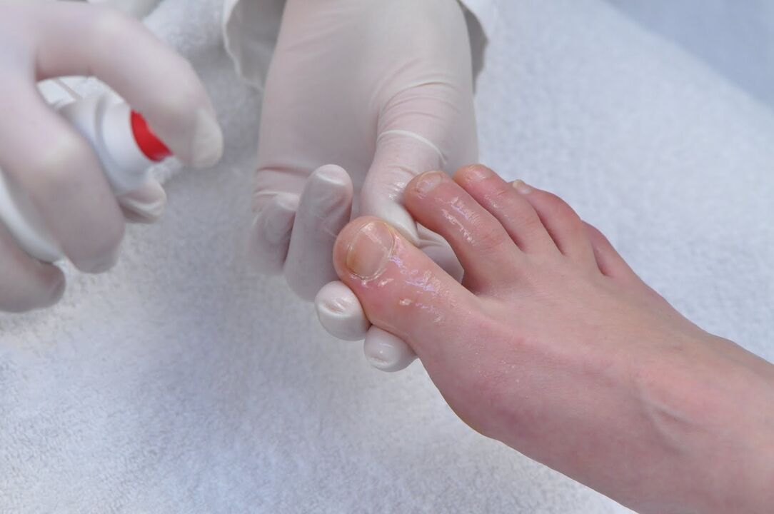 tratamiento de las uñas de los pies para hongos