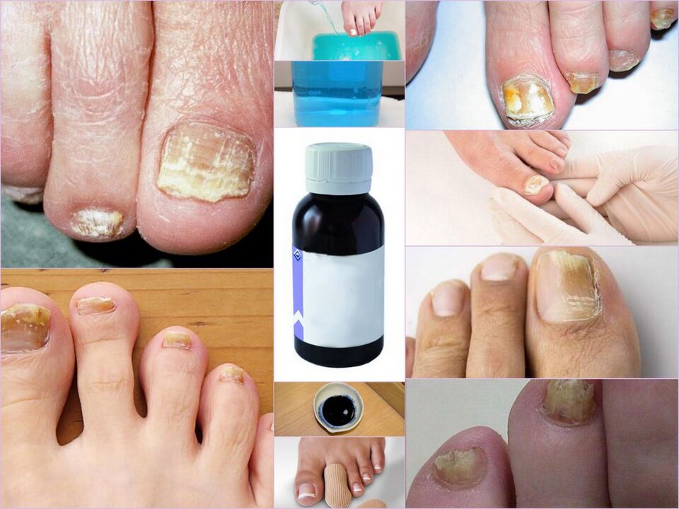 medicamentos para hongos en las uñas de los pies
