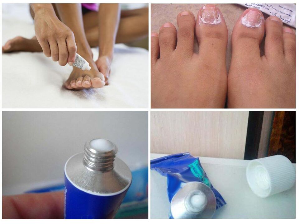 preparaciones farmacéuticas efectivas contra hongos en las uñas