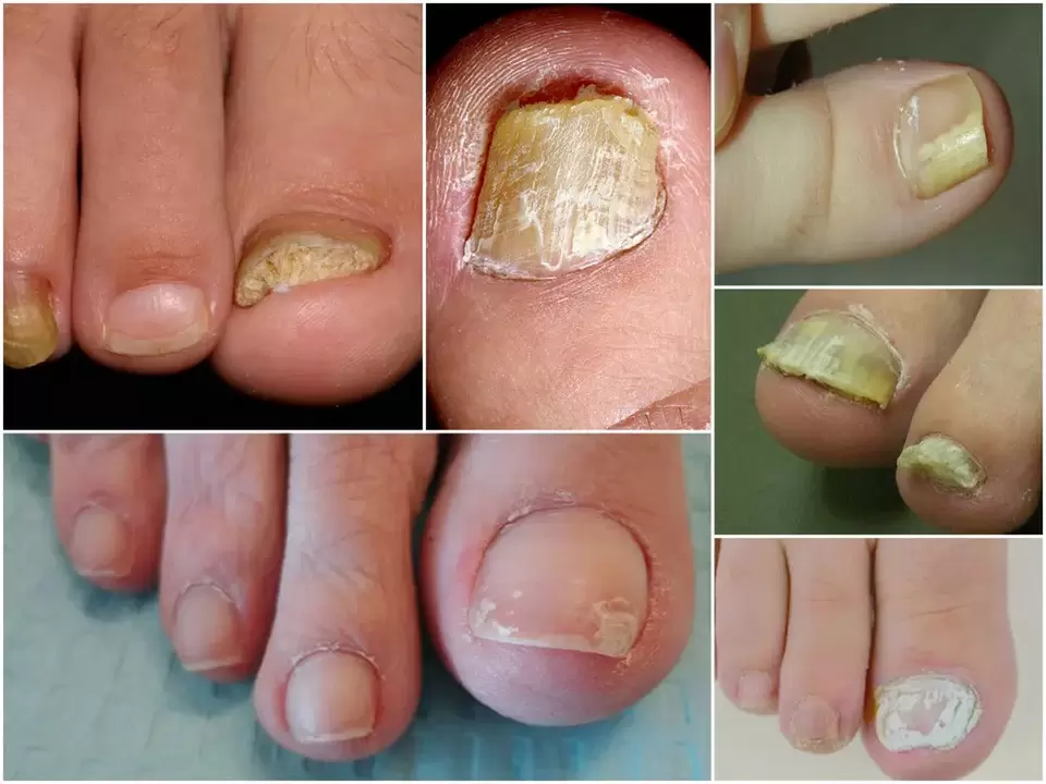 Aparición de diferentes formas de onicomicosis.