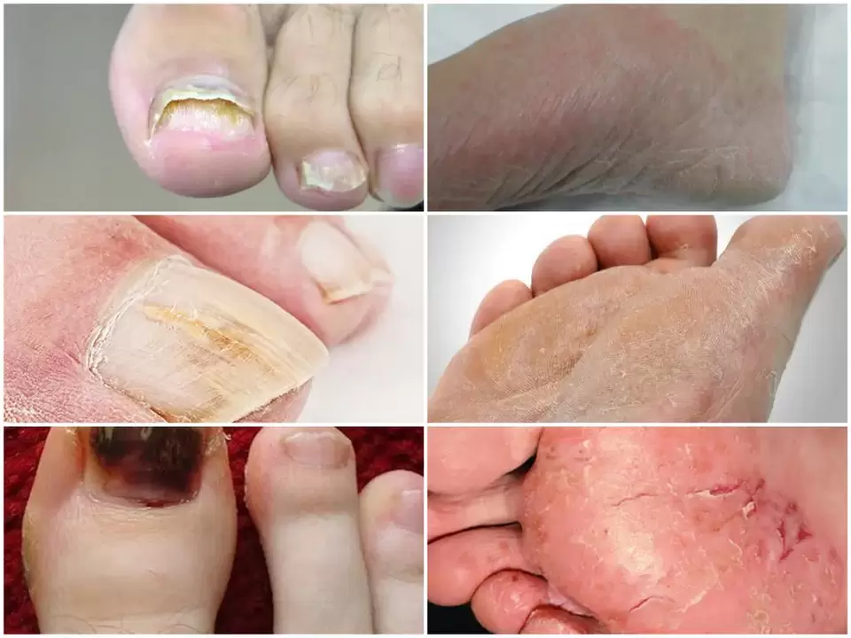 Manifestaciones de hongos en los pies por diversos patógenos.