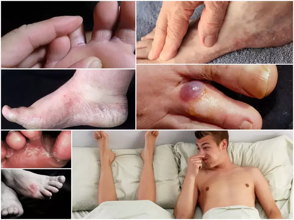 Principales signos de hongos en los pies.
