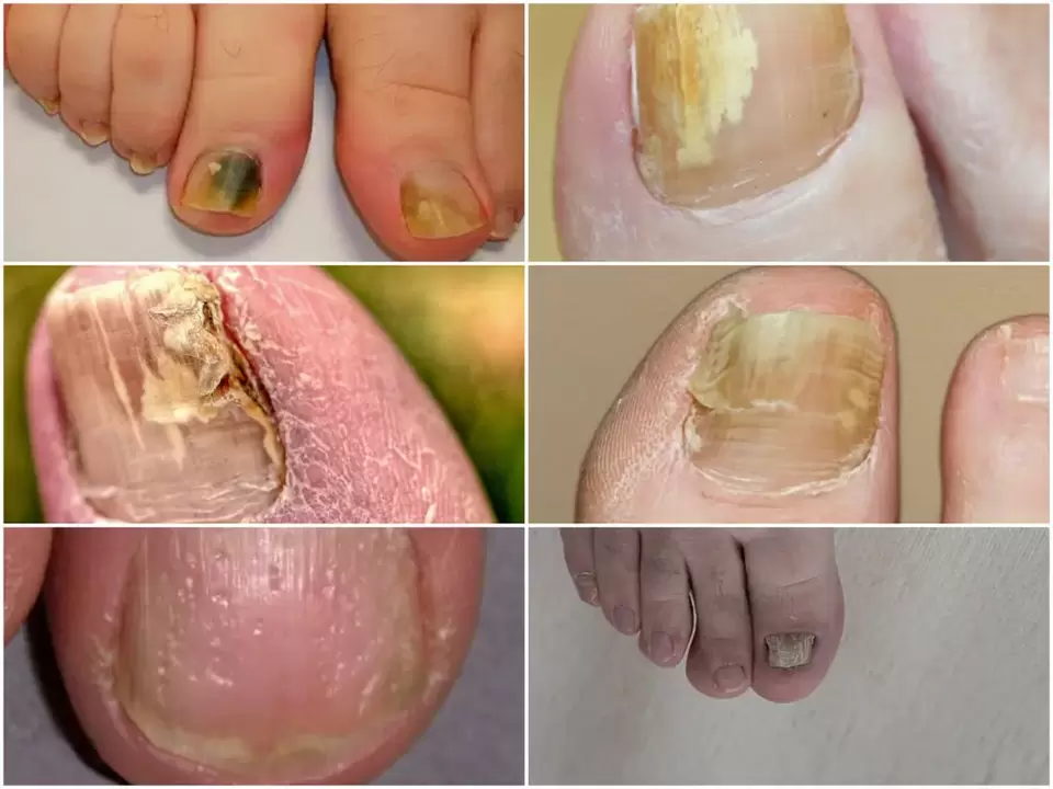 Síntomas de onicomicosis cambios en el color y la estructura de las uñas.