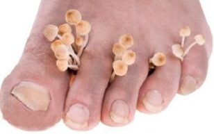 Onicomicosis de las uñas de los pies