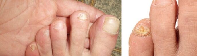 foto de manifestaciones de hongos en las uñas de los pies