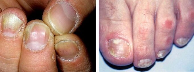 manifestaciones de una infección por hongos en las uñas