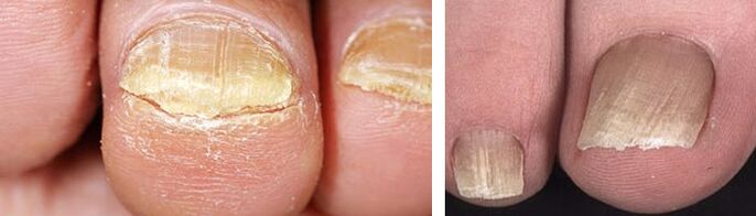 daño a las uñas con una infección por hongos