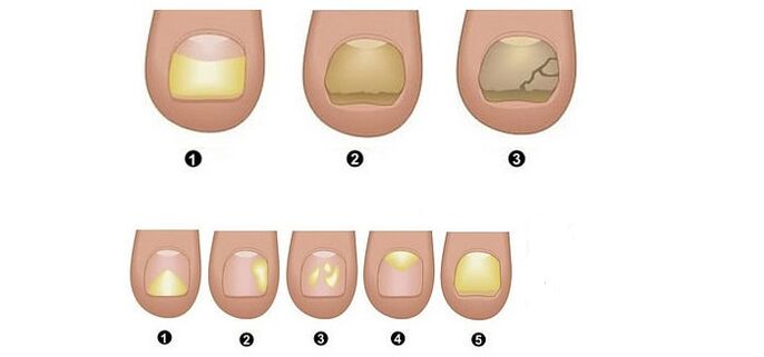 etapas y síntomas de hongos en las uñas de los pies