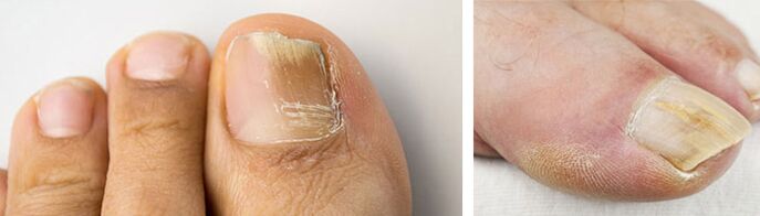 foto de una infección por hongos en la uña del dedo gordo del pie