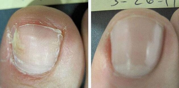 antes y después del tratamiento de hongos en las uñas