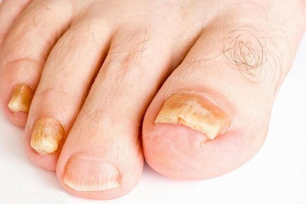 ¿Cómo se ven los hongos en las uñas de los pies 