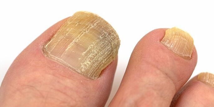 daño a las uñas con infección fúngica avanzada