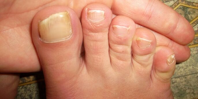 daño a las uñas de los pies con hongos