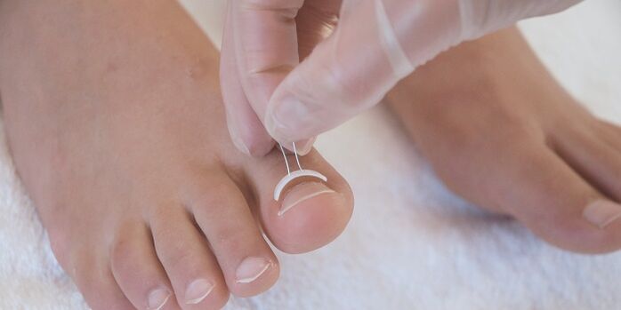 extracción de una uña del pie con un hongo