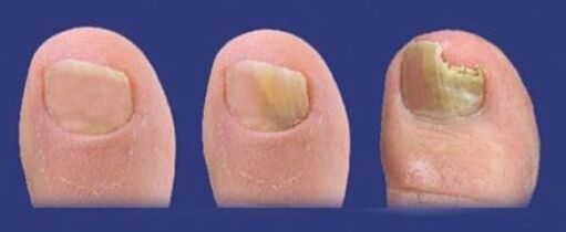 etapas de desarrollo del hongo en las uñas de los pies. 