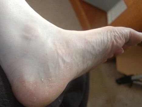 descamación del pie de la pierna como signo de infección por hongos