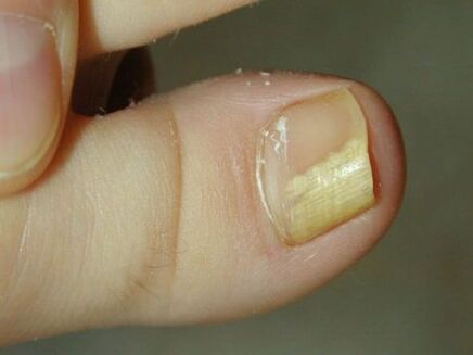 hongo subungueal en las uñas
