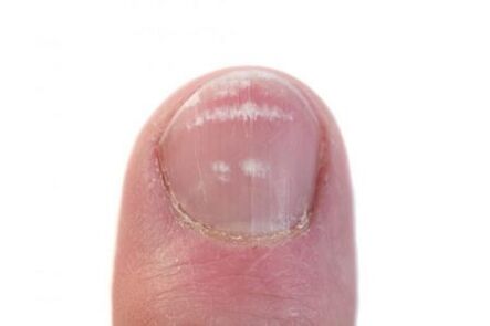 la etapa inicial de la infección por hongos en las uñas