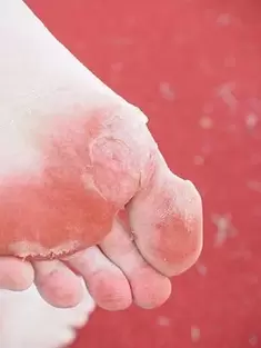 síntomas de hongos en los pies